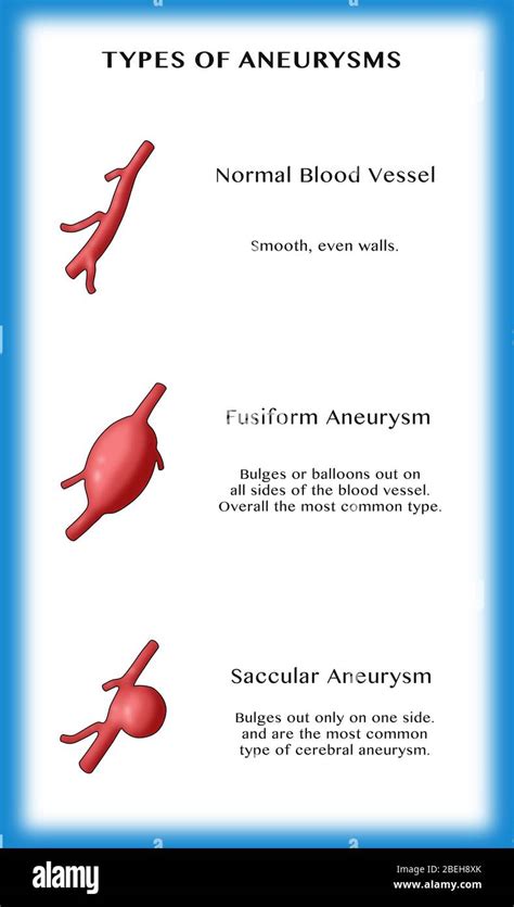 types  aneurysms stock photo alamy