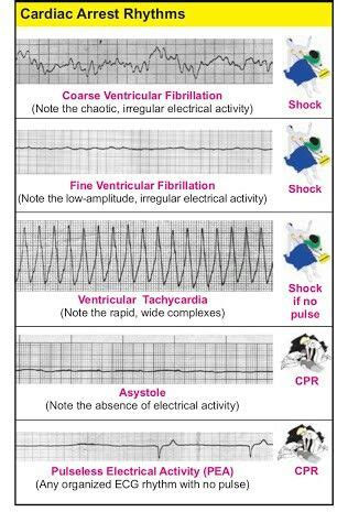 shockable   shockable rhythms charles vance