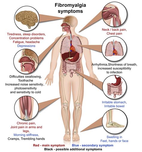 Fibromyalgia — Outline Health | Osteopath Farnham | Osteopath Odiham