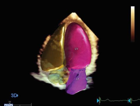 Heartmodel Philips Healthcare