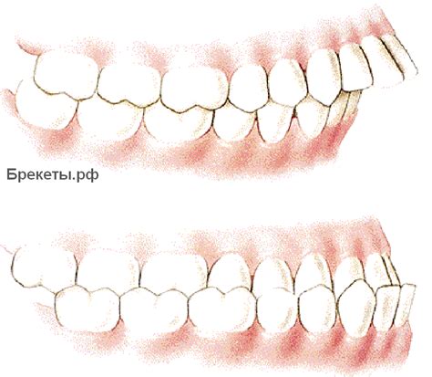 Прикус зубов и его исправление. Неправильный прикус: лечение брекетами ...