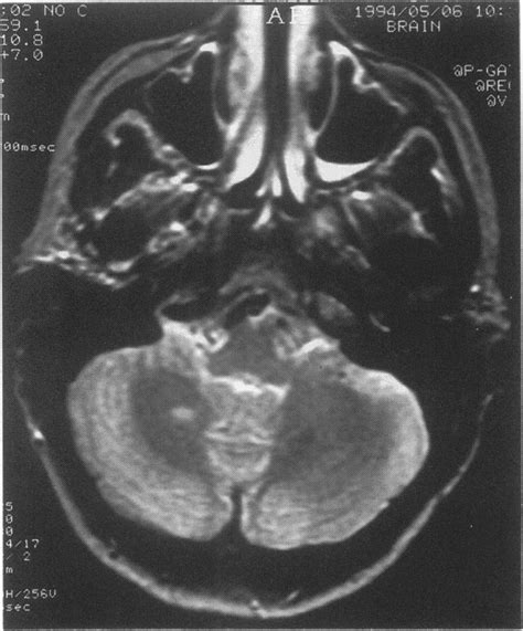 Axial T2w Mri Through The Lower Posterior Fossa Demonstrating A High