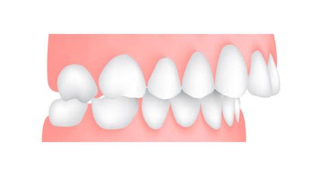 Types Of Malocclusions Causes Symptoms And Treatmentsdr Jacquie