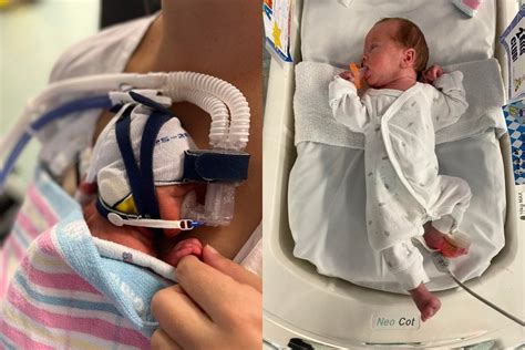 Premature Baby 32 Weeks