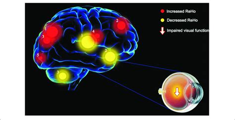 The Reho Values Of The Altered Brain Regions Variable Degree Of The