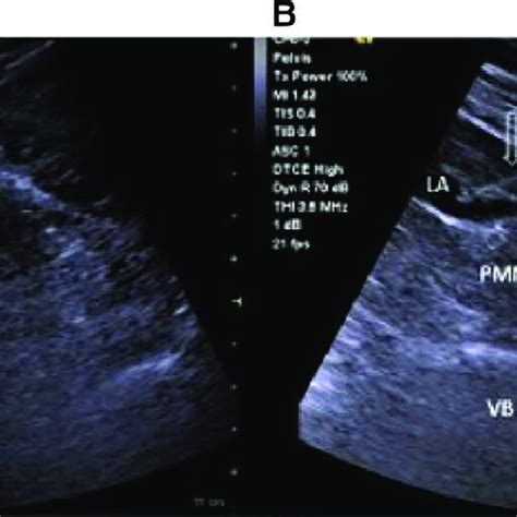 Quadratus Lumborum Block-2. (A) An ultrasound-visible block needle was... | Download Scientific ...