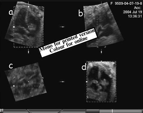 Three Dimensional Multiplanar Slicing Of The Four Chamber View With