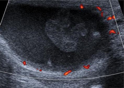 Us Of The Tunica Vaginalis Testis Anatomic Relationships And Pathologic Conditions Radiographics