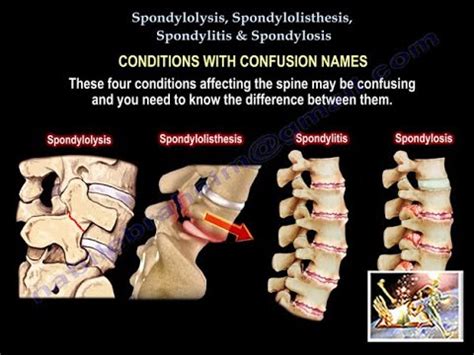 spondylolysis spondylolisthesis spondylitis spondylosis