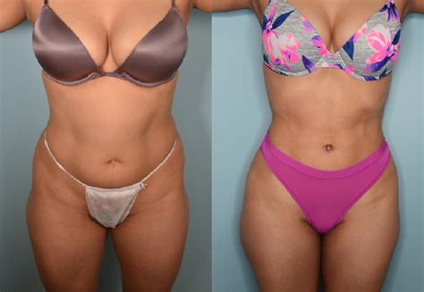 Tummy Tuck Abdominoplasty Patient 2 Dr Raúl López