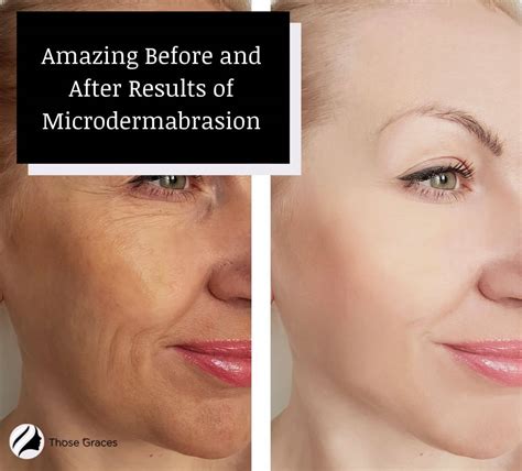 Albums 94 Pictures Before And After Pictures Of Microdermabrasion Sharp