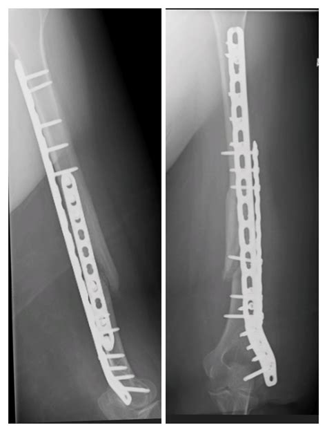 Seeing the bone through the plates : r/brokenbones