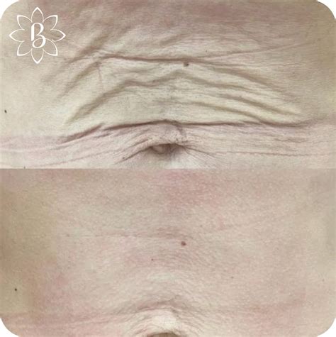 До и после контурной пластики - фото | клиника «Красивые люди» в Петербурге