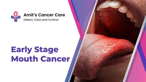 Explore Early Stage Mouth Cancer From Dr Amit Chakraborty