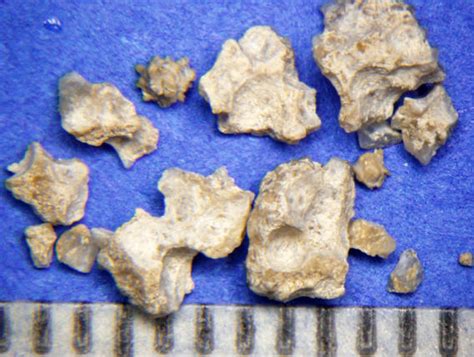 Struvite Kidney Stones