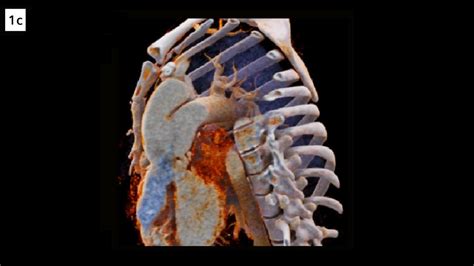 Unrepaired Persistent Truncus Arteriosus In An Adult Siemens Healthineers