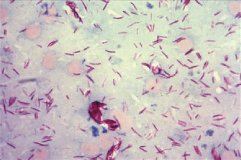 Mycobacterium Tuberculosis Acid Fast Stain 