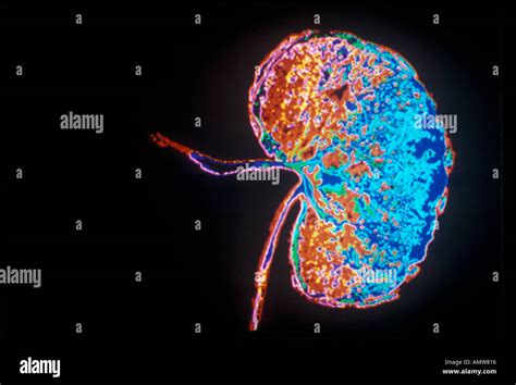 Kidney mri hi-res stock photography and images - Alamy