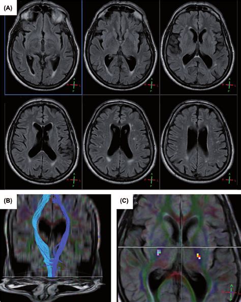 Patient ’ S Brain Magnetic Resonance Imaging A Flair In The Axial Download Scientific