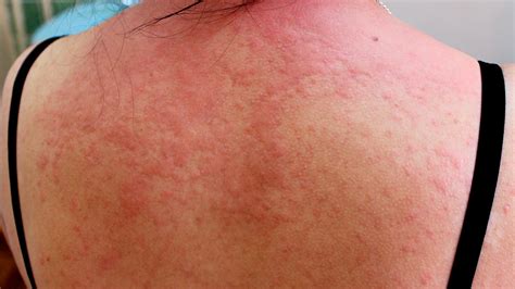 Itchy Rash On Back Treatment At Mildred Rohe Blog