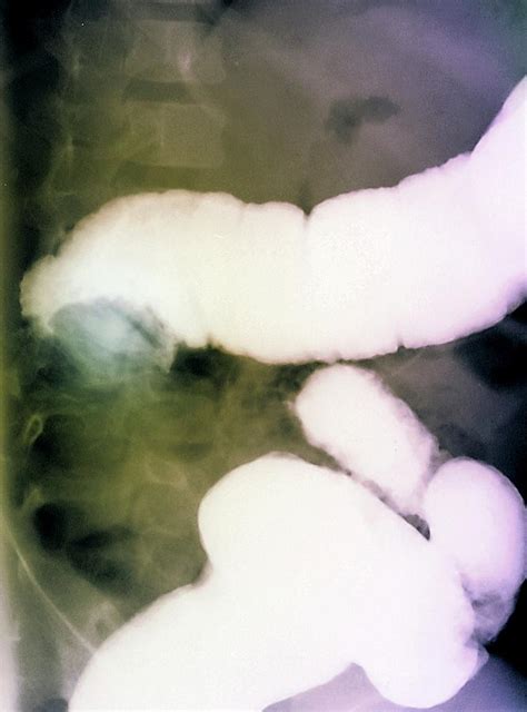 Intussusception Of The Intestines Photograph By Zephyr Pixels