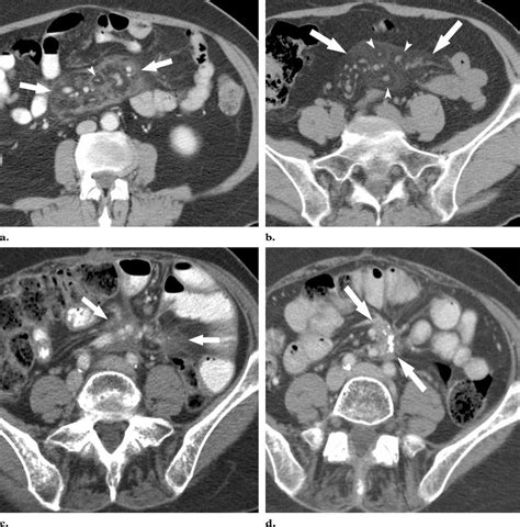 Sclerosing Mesenteritis Axial Contrast Enhanced Ct Images Show Download Scientific Diagram