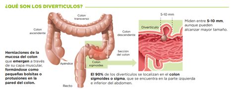 O Que É Divertículos Cólicos - Los divertículos representan la afección más frecuente de colon
