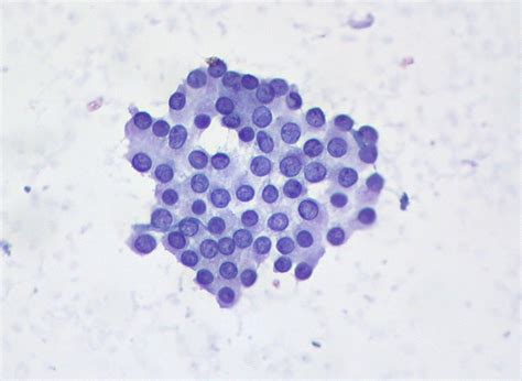 Papillary Carcinoma Of The Thyroid Fna Pap Stain Flickr