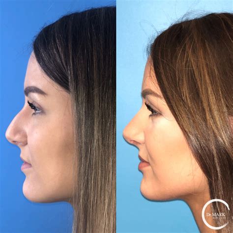 Rhinoplasty Gallery Dr Markarian