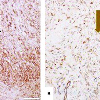 Immunohistochemical Staining Of The Tumor Cells Showed A Positivity