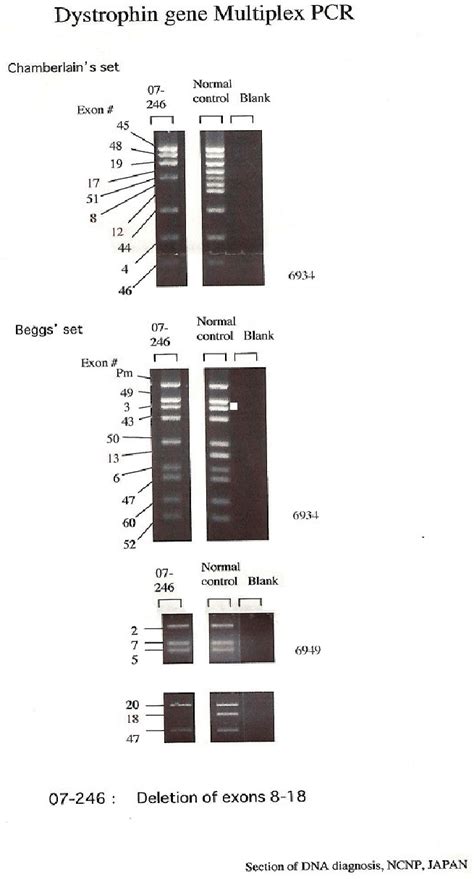 Patient Number 2 With Dystrophin Gene Deletion At Exon 8 18 The