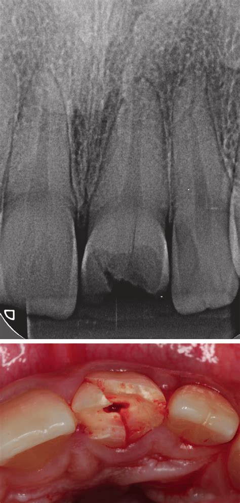 Periapical Radiograph Of The Fractured Tooth Figure 4 Clinical Aspect