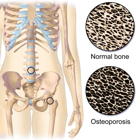 Osteoporosis Vertebral Augmentation For Compression Fractures