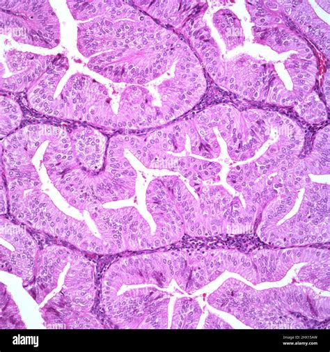 Endometrioid Carcinoma Grade Light Micrograph Stock Photo Alamy