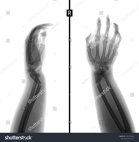 X Ray Wrist Greenstick Fracture Radius Negative Stock Photo 1283756854