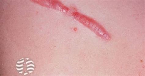 Keloid Scar Image