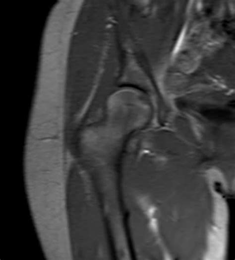 PLAN ARTHROGRAM HIP localizer - mrimaster