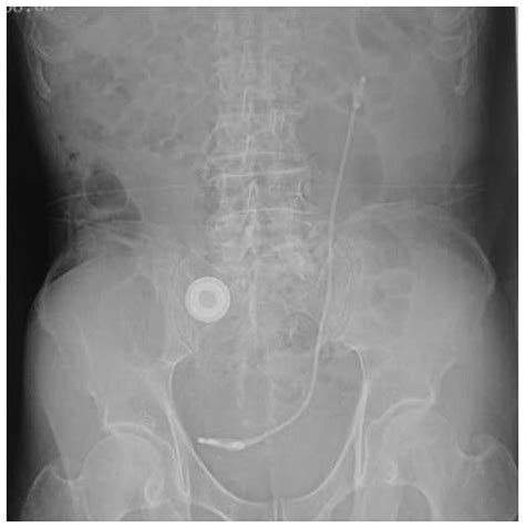 Как Выглядит Мочеточник У Женщин Снаружи Фото – Telegraph