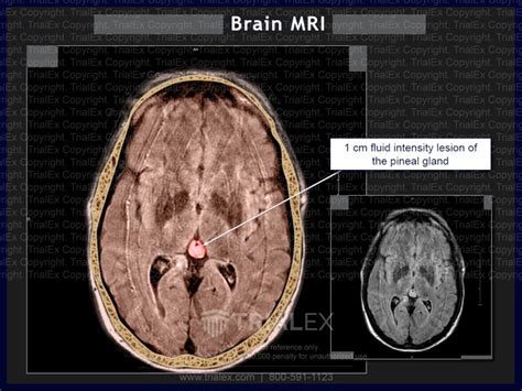 Brain MRI: pineal gland lesion - Trial Exhibits Inc.