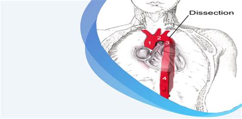 Aortic Dissection