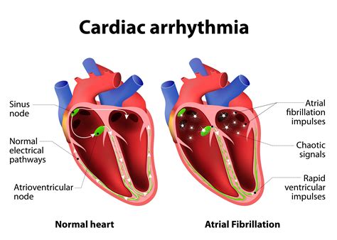 Atrial Fibrillation Testing | The Harley Street