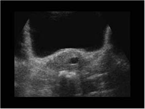 Gynaecology | 3.1 Uterus : Case 3.1.2 Miscellaneous benign uterine and cervical lesions ...