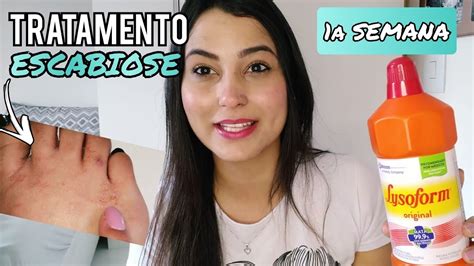 Como Tratar A Sarna Humana - INICIEI O TRATAMENTO CONTRA ESCABIOSE | SARNA HUMANA | 1a SEMANA | CRIS ...