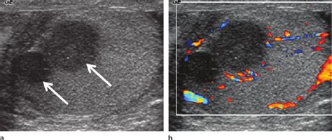 Epididymal Granuloma Ultrasound