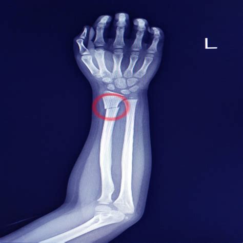 Radius Fracture - jrc