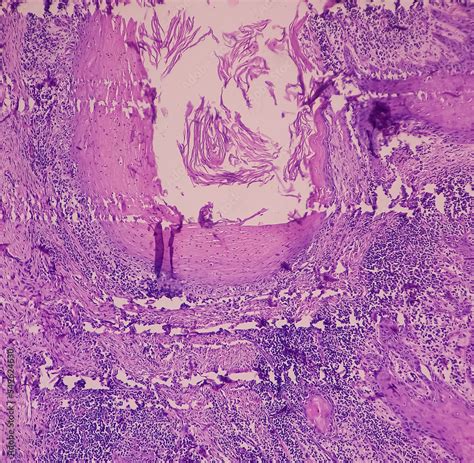 Finger Biopsy Finger Cancer Invasive Squamous Cell Carcinoma Grade