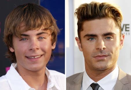 Zac Efron Plastic Surgery | Longevita