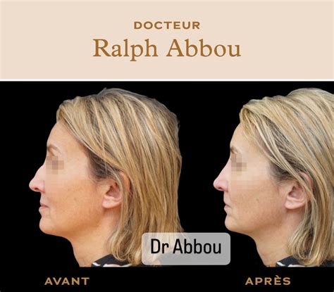 Rhinoplastie médicale Paris Dr Ralph Abbou