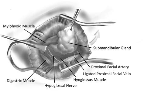 Surgical Excision Of The Submandibular Gland Operative Techniques In