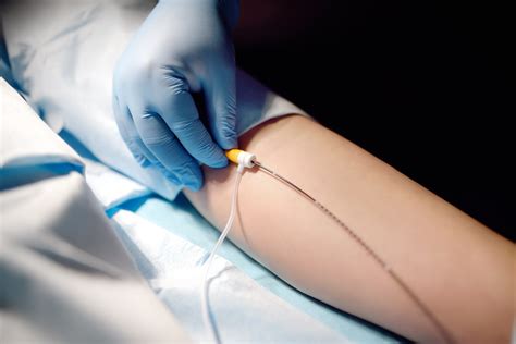 Endovenous Ablation: A Modern Solution for Varicose Vein Damage